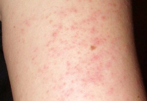 Niežtintis odos bėrimas - kirminų buvimo kepenyse simptomas